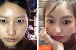 杭州求是眼科醫(yī)院姚玉峰整形價格表附切開雙眼皮案例展示