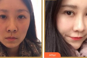 杭州品凱口腔醫(yī)院錢相宇整形價格表附眼部綜合案例展示