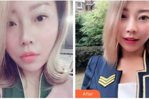 杭州品凱口腔醫(yī)院陳亮整形價格表附牙齒隱形矯正案例展示