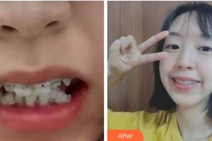 杭州品凱口腔醫(yī)院鄭志春整形價格表附牙齒陶瓷矯正案例展示