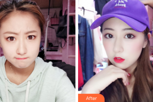 廣州市中西醫(yī)結(jié)合醫(yī)院燒傷整形外科劉移峰整形價(jià)格表附微針?biāo)獍咐故?>
</a>
<h3 class=