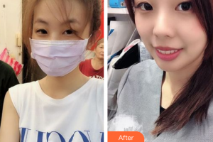 廣州市中西醫(yī)結(jié)合醫(yī)院燒傷整形外科黃錦剛整形價(jià)格表附光子嫩膚案例展示