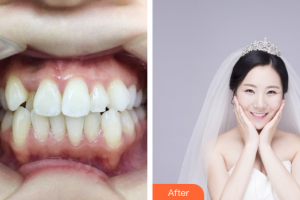 中信惠州醫(yī)院醫(yī)學(xué)整形中心常淑霞整形價(jià)格表附金屬托槽矯正案例展示