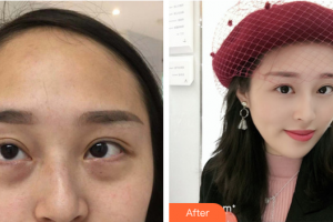 惠州伊麗莎白整形美容醫(yī)院劉本清整形價(jià)格表附祛眼袋案例展示