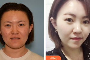 惠州市中心人民醫(yī)院整形燒傷科黃建華整形價(jià)格表附清潔祛痘案例展示