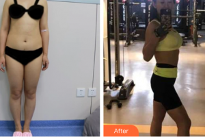 惠州伊麗莎白整形美容醫(yī)院安東顯整形價(jià)格表附美體塑形案例展示