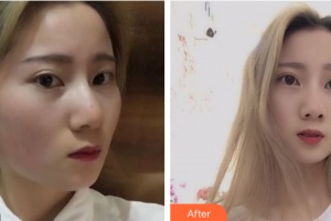 惠州市中心人民醫(yī)院整形燒傷科余林權(quán)整形價格表附果酸換膚案例展示