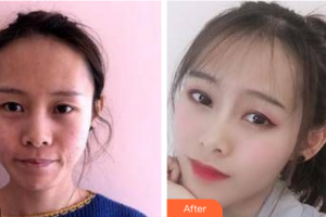 惠州鵬愛醫(yī)療美容醫(yī)院申濤整形價格表附埋線提升案例展示