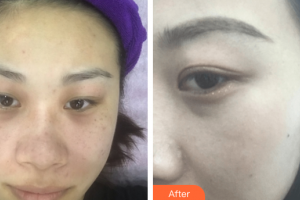 中信惠州醫(yī)院醫(yī)學(xué)整形中心柏松整形價(jià)格表附超激光美膚+祛斑針案例展示