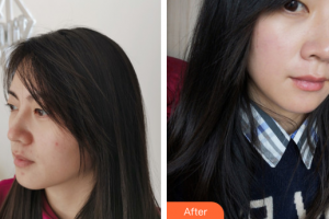 中信惠州醫(yī)院醫(yī)學(xué)整形中心何輝整形價(jià)格表附果酸換膚案例展示