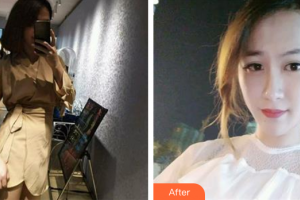 中信惠州醫(yī)院醫(yī)學(xué)整形中心吳正峯整形價格表附點陣激光祛妊娠紋案例展示