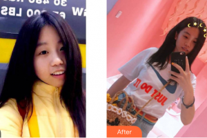 中信惠州醫(yī)院醫(yī)學(xué)整形中心王少榮整形價格表附超聲波潔牙案例展示