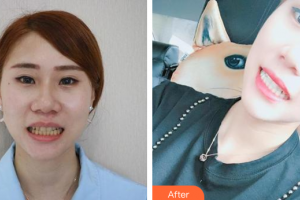 中信惠州醫(yī)院醫(yī)學(xué)整形中心伍粵桂整形價格表附牙齒美白案例展示