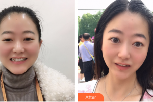 中信惠州醫(yī)院醫(yī)學(xué)整形中心單成方整形價格表附隱形牙齒案例展示