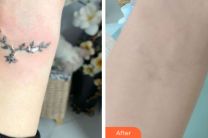 惠州伊麗莎白整形美容醫(yī)院高珊整形價格表附超激光美膚洗紋身案例展示