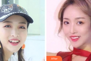 惠州鵬愛醫(yī)療美容醫(yī)院張澤火整形價格表附隱形托槽矯正案例展示