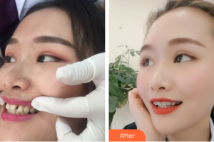 惠州鵬愛醫(yī)療美容醫(yī)院汪林整形價格表附隱形托槽矯正案例展示