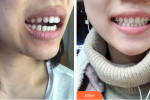 惠州白天鵝口腔醫(yī)院張麗紅整形價格表附牙齒隱形矯正案例展示