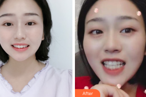 惠州白天鵝口腔醫(yī)院歐雪輝整形價格表附隱適美全隱形矯正案例展示