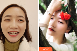 惠州白天鵝口腔醫(yī)院鞠遠(yuǎn)福整形價格表附隱形矯正案例展示