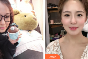 惠州白天鵝口腔醫(yī)院李芃整形價格表附金屬托槽矯正案例展示