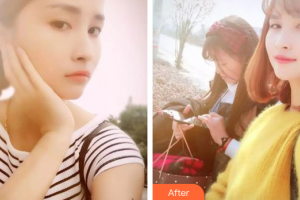 惠州白天鵝口腔醫(yī)院王文壇整形價格表附皓齒美白案例展示