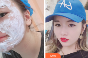 中信惠州醫(yī)院醫(yī)學(xué)整形中心余文建整形價格表附微針美膚案例展示