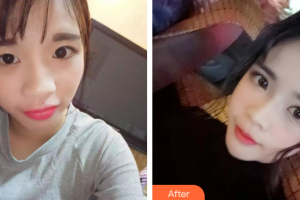 惠州雅涵醫(yī)療美容門診部曾詳宏整形價格表附無針?biāo)獍咐故?>
</a>
<h3 class=