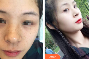 惠州劉偉勇醫(yī)療美容診所劉曉韜整形價格表附激光祛斑案例展示