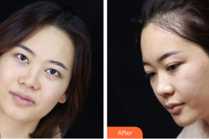 惠州市第一人民醫(yī)院眼科丁嬙整形價格表附眼部綜合案例展示