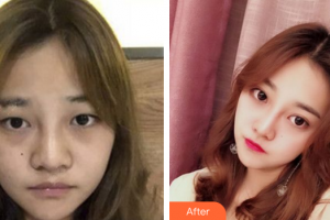 惠州市第一人民醫(yī)院眼科馮育基整形價格表附眼部手術(shù)案例展示