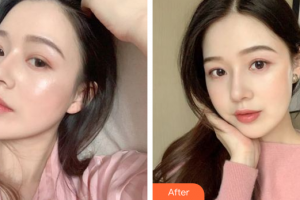 惠州市第六人民醫(yī)院眼科葉洪娜整形價(jià)格表附眼部整形案例展示