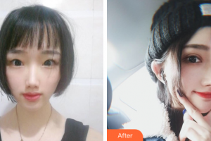 惠州市第一人民醫(yī)院眼科廖潤(rùn)斌整形價(jià)格表附雙眼皮案例展示