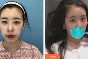 惠州市第一人民醫(yī)院眼科徐象周整形價(jià)格表附全切雙眼皮案例展示