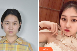 韶關(guān)愛(ài)爾眼科醫(yī)院馬麗娜整形價(jià)格表附眼部整形案例展示