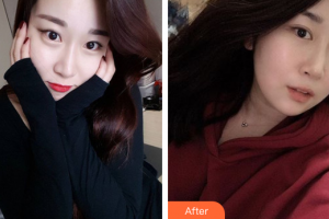 韶關(guān)愛(ài)爾眼科醫(yī)院王愛(ài)琴整形價(jià)格表附全切雙眼皮案例展示