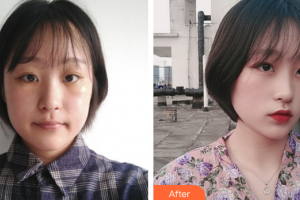 韶關(guān)愛(ài)爾眼科醫(yī)院蔡欣整形價(jià)格表附祛眼袋案例展示