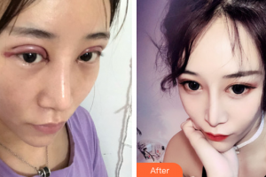 韶關(guān)愛(ài)爾眼科醫(yī)院詹衛(wèi)群整形價(jià)格表附切開(kāi)雙眼皮案例展示