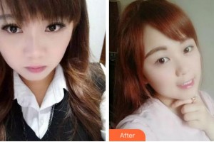 杭州品凱口腔醫(yī)院張存好整形價格表附牙齒隱形矯正案例展示