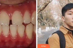 杭州品凱口腔醫(yī)院張城鎮(zhèn)整形價格表附金屬托槽矯正案例展示