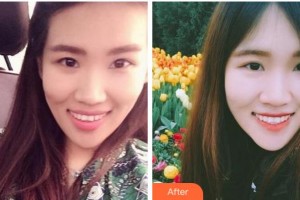 杭州品凱口腔醫(yī)院盧睿敏整形價格表附牙齒隱形矯正案例展示