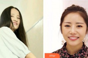 杭州市富陽區(qū)第一人民醫(yī)院燒傷整形外科唐曉明整形價格表附牙齒隱形矯正案例展示