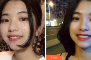 杭州富陽口腔醫(yī)院葉寶定整形價格表附牙齒隱形矯正案例展示