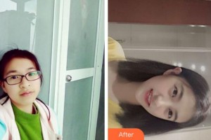 杭州亮貝美口腔醫(yī)院水文軍整形價格表附金屬托槽矯正案例展示