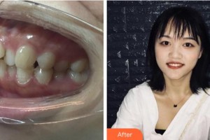 杭州臻好口腔門診部徐丹整形價格表附金屬托槽矯正案例展示