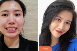 杭州西湖口腔醫(yī)院葉論整形價(jià)格表附牙齒隱形矯正案例展示