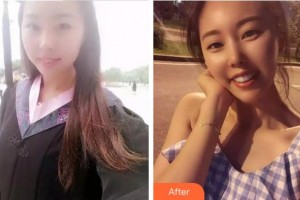 杭州西湖口腔醫(yī)院王城整形價(jià)格表附牙齒陶瓷矯正案例展示