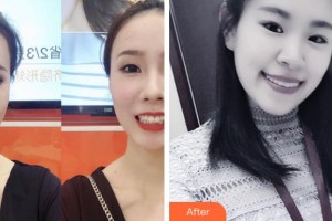 杭州西湖口腔醫(yī)院王慧敏整形價(jià)格表附牙齒隱形矯正案例展示