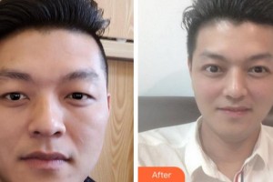 杭州太學(xué)眼科門診部周玉柱整形價(jià)格表附切開(kāi)雙眼皮案例展示