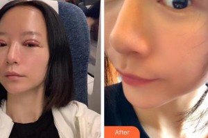 杭州太學(xué)眼科門診部林丕容整形價(jià)格表附切開(kāi)雙眼皮案例展示